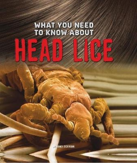 Picture of What You Need to Know about Head Lice